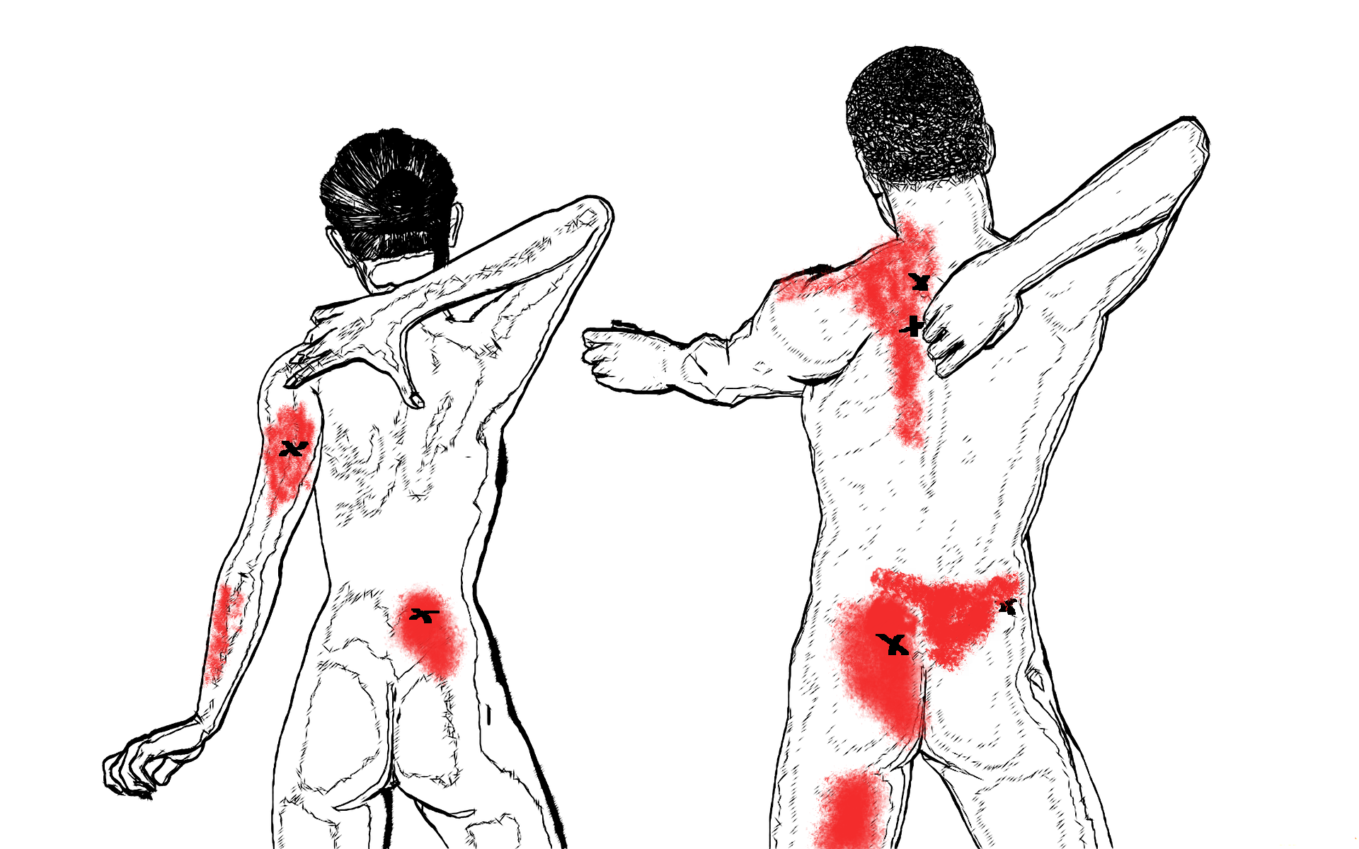 About myofascial trigger points